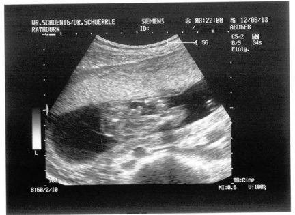 Ultrasound 12June2013c
